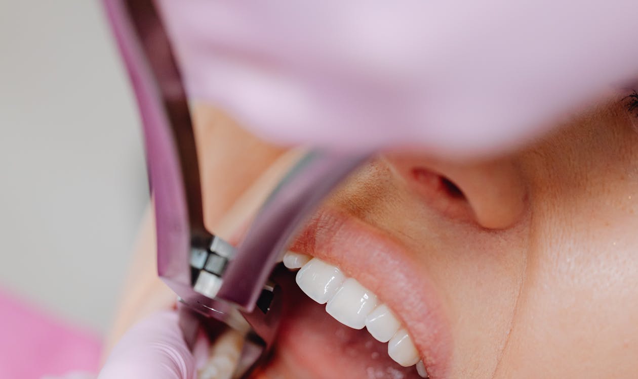 Oral surgery procedure, tooth extraction being performed