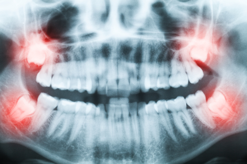 Tooth extraction procedure